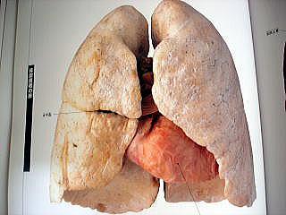 肺健常者１.jpg