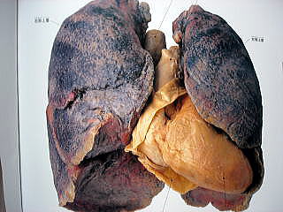 肺喫煙者１.jpg