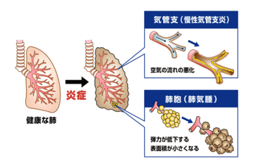 慢性気管支炎　肺気腫.gif