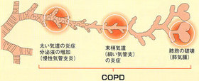 COPD.jpg