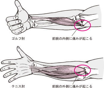 ゴルフ肘.gif