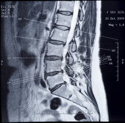 MRI椎間板.jpg